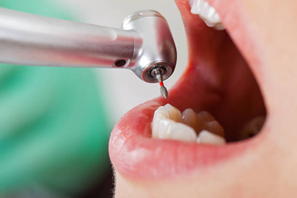 Best Emergency Root Canal Treatment in Port Angeles East, WA